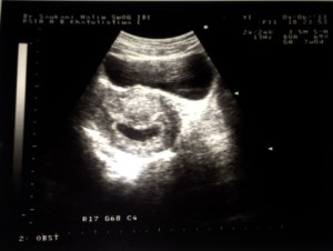 Hasil USG tanggal 4 Juni 2013. Usia kandungannya 7 minggu :)